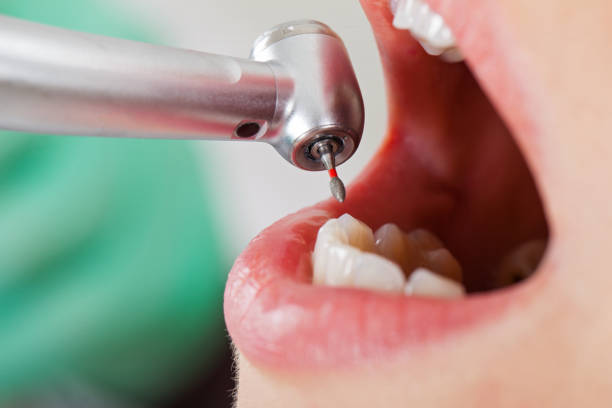 Best Emergency Dental Care for Broken or Chipped Teeth in York, SC